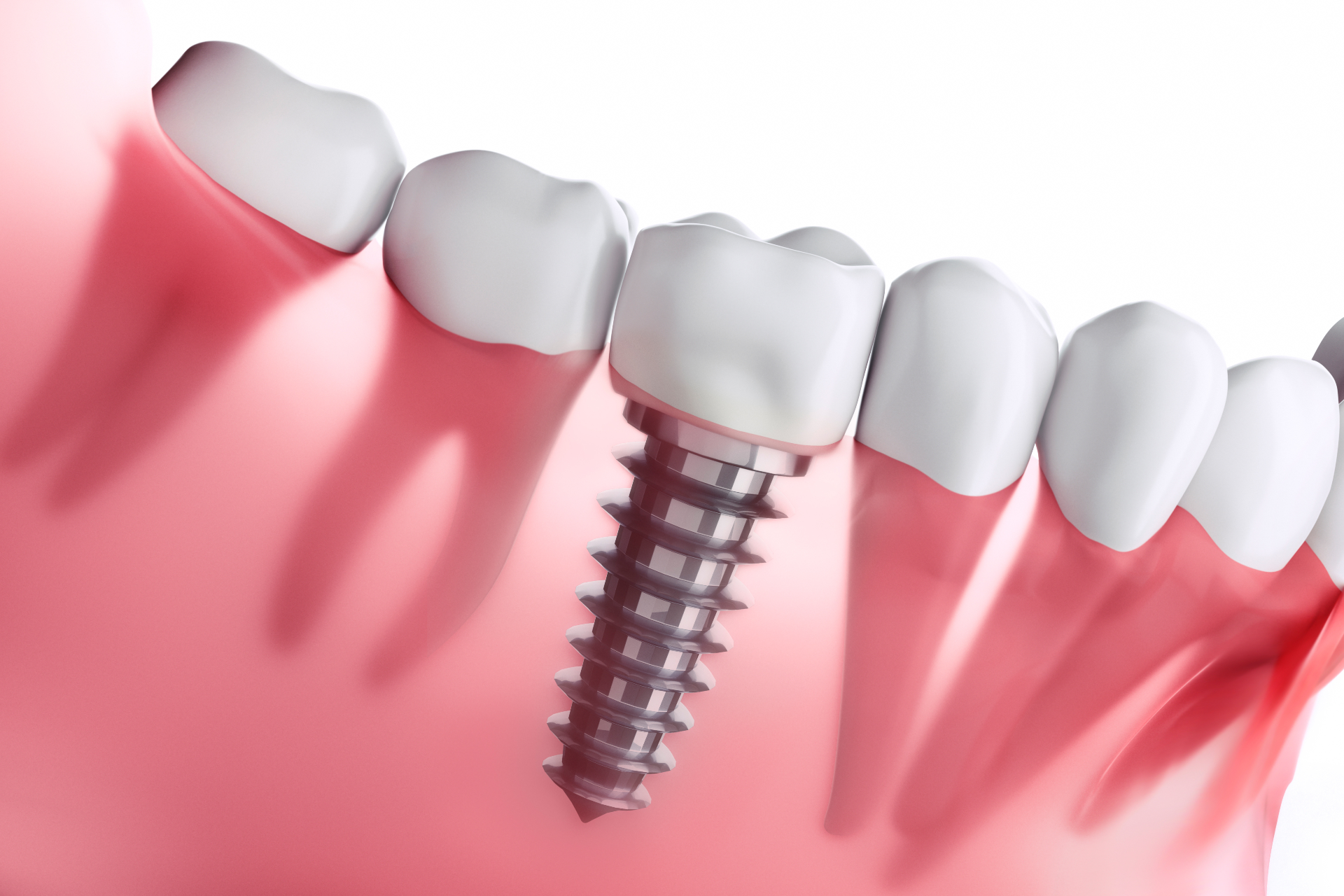 Tot ce trebuie sa stii despre implanturile dentare – Dr. Cristina Coman, Ogodent Ploiesti