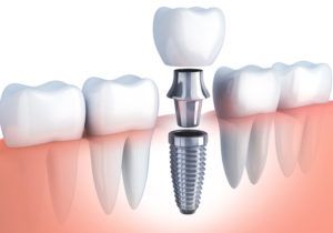 Implanturi dentare